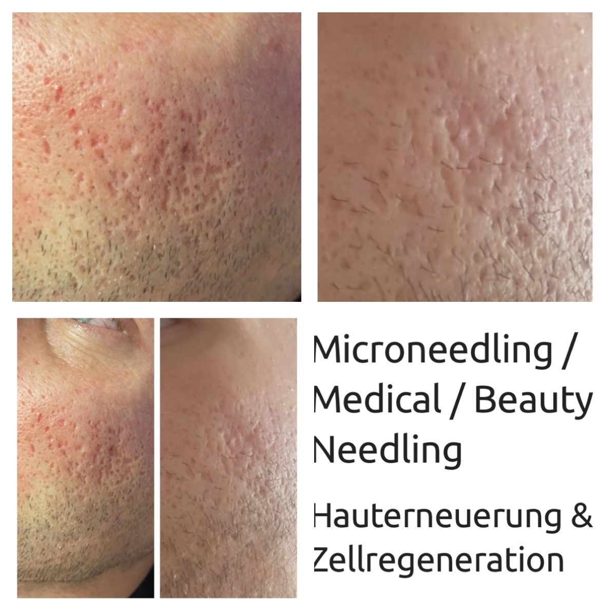 Microneedling Profi vs. Dermaroller